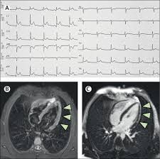심근에 기질적인 변화가 오고 거기에 염증이 생기는 병이다. Myocarditis In A 16 Year Old Boy Positive For Sars Cov 2 The Lancet