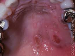 Image result for Mouth ulcers symptoms roof of the mouth