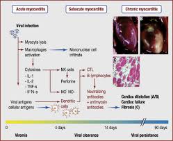 Myocarditis has many different causes and can result in a range of outcomes from mild (presenting briefly and resolving) to rapidly progressing fatal disease. Viral Causes Of Human Myocarditis Sciencedirect