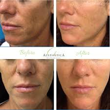 Refresh, Don't Reshape. This client wanted a subtle refresh—not a major  change. She came to AestheticA in Middleton and started with a Juvéderm  Skinvive treatment and using medical-grade skincare. One month later,