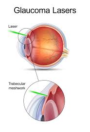 Most people who have glaucoma can have their eye pressure lowered by these therapies to prevent, stop, or slow the progression of glaucoma vision loss. Slt Laser Surgery Treats Glaucoma And Vision Loss Papale Eye Center