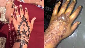 Mereka adalah objek yang sangat sempurna untuk dijadikan bahan lukisan. Mengerikan Gara Gara Pakai Henna Akibatnya Jadi Fatal Menimpa Gadis Ini Tribun Lampung