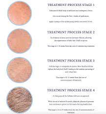 That said, some males may experience growth into their early 20s. Moth Hair Loss Treatment Penis Enlargement And Growth Facebook