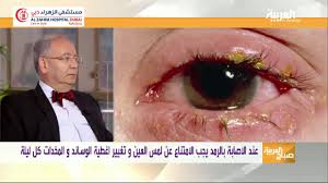 تعرف على أسباب رمد العين و طرق العلاج السريع مع الدكتور ياسر مستشفى الزهراء دبي Youtube