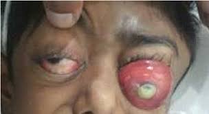 Image result for Proptosis