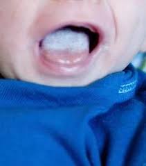Is That Really Thrush On Your Baby S Tongue Milk Matters Infant Feeding Solutions