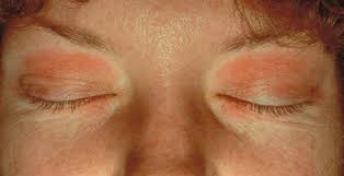 Symptoms such as fever, rashes (not caused by irritation from drooling) and diarrhea are not associated with teething. Eyelid Dermatitis Xeroderma Of The Eyelids Eczema Of The Eyelids Atopic Dermatitis Allergic Contact Dermatitis Irritant Contact Dermatitis Seborrheic Dermatitis Of The Eyelids Dermatology Advisor