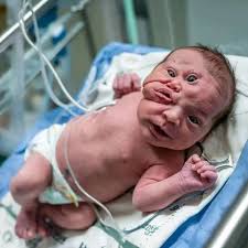 Support for baby born with rare condition