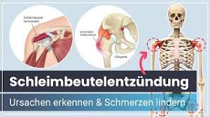 Sag Lastigen Schleimbeutelentzundungen Den Kampf An 7 Effektive Tipps Und Massnahmen