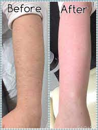 Body hair, or androgenic hair, is the terminal hair that develops on the human body during and after puberty.it is differentiated from the head hair and less visible vellus hair, which is much finer and lighter in color.the growth of androgenic hair is related to the level of androgens (often referred to as male hormones) and the density of androgen receptors in the dermal papillae. Pin On Skin Care And Hair Removal