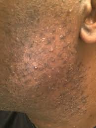 Why do beards get ingrown hairs? Routine Help I Need Help Developing A Shaving Face Cleaning Routine To Combat Ingrown Facial Hairs Skincareaddiction