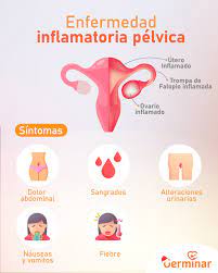 Germinar Centro De Fertilidad La Enfermedad Inflamatoria Pelvica Es Una Infeccion De Los Organos Reproductores Femeninos Que Ocurre Por Presencia De Una Ets Puede Causar Cicatrices En El Utero