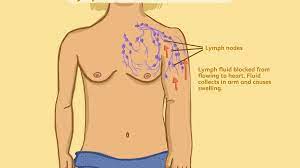 It took over a year for me to feel somewhat like myself again. Lymphedema In Breast Cancer Symptoms Causes Diagnosis And Treatment