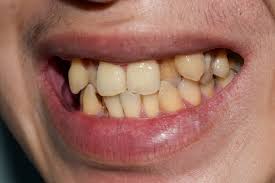 Fixing Snaggle Tooth With Invisible Aligners | Ez Smile