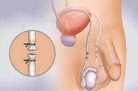 Consiste en la sección y ligadura de los conductos deferentes. Vasectomia En Toluca Dr Ricardo Galicia Urologo
