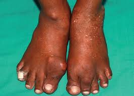 Gout Foot Tophi In 2020 Gout Gout In Hands How To Cure Gout