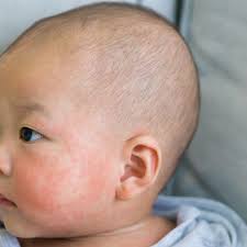 Di antara penyebab ruam adalah: Penting Ini Fakta Seputar Eksim Susu Pada Bayi