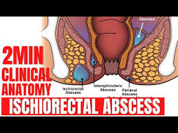 Image result for Ischiorectal Abscess