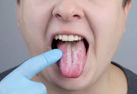 Image result for Sialoadenitis