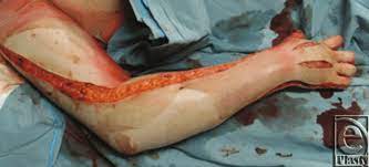 The procedure is done to prevent circulation issues, tissue damage, and even tissue death that can result. Burned Extremity After Escharotomy Download Scientific Diagram