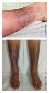 Image result for Lipodermatosclerosis