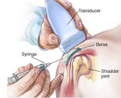 It is located anterior to the subscapularis muscle and inferior to the coracoid process.its function is to reduce friction between the coracobrachialis, subscapularis and short head of the biceps tendons, thus facilitating internal and external rotation of the shoulder. Shoulder Bursitis Physiopedia
