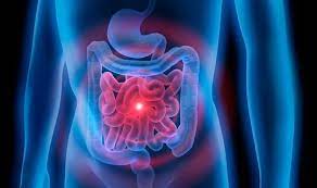 Steroide Bei Morbus Crohn Und Colitis Ulcerosa Ced Netdoktor At