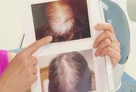 Other popular uses of emu oil include joint or muscle pain, burns, and shingles, eczema, scars (especially acne scars), stretch marks, and as a facial moisturizer. The Best Hair Restoration Procedures Hair Loss Treatments