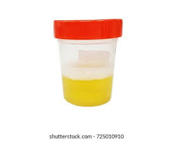 Image result for Isolated Proteinuria