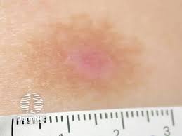 Image result for Postinflammatory Hyperpigmentation