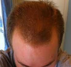 Grateloupia elliptica, the red algae, has been reported to prevent hair loss in vitro. My Progress So Far Pictures Hairlosstalk Forums