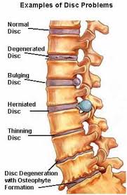Lumbar Laminectomy Spine Surgery Cost India Lumbar Laminectomy Surgery