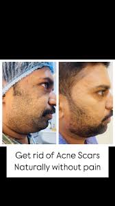 #acnescars #acnetreatment, #aestheticmedicaltraining #aestheticdermatology,  #dermatologiaestetica #milano #dubai #exosomes #scars #activeacne  #acneattiva, #drjibigeorge , #prp #plasmaenergy ...