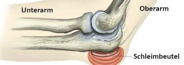 Schleimbeutelentzundung Bursitis Gesundheits Wiki