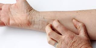 Gel ini memang ampuh menghilangkan gatal di badan sekaligus menyejukkan kulit, terlebih jika gatal pada kulit anda disebabkan oleh gigitan nyamuk dan luka bakar. Penyebab Kulit Lansia Gatal Dan Cara Mengatasinya