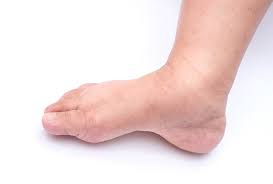 Most of these conditions are dermatological in nature and, more often than not, treatable. Symptoms Of Vein Disease Vein Treatment Center In Houston Tx
