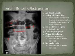 Pin By Great Wolf On Ileus Small Bowel Obstruction Bowel Obstruction Bowels