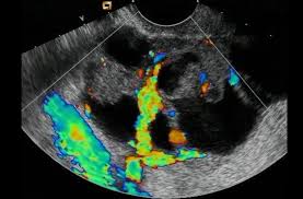 An ultrasound can occasionally identify a mass as ovarian cancer but should not be used to rule out ovarian cancer if a mass is not detected, explains rob. Ovarian Cancer Diagnosis Ultrasound May Better Detect Malignant Adnexal Masses Than Mri