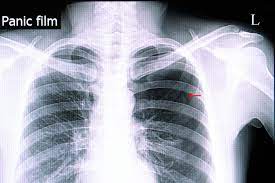 Consult a doctor for medical advice. Pneumothorax Symptome Therapie Heilung