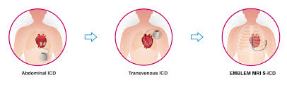 Image result for Internal Cardiac Defibrillator