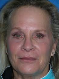 Skin Laser in Toledo