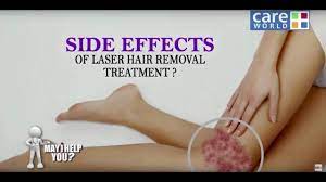 Laser hair removal is the vogue with people wanting a solution to hair removal that is more permanent than some other methods. Is Laser Hair Removal Safe Mihy Dr Puneet Sarogi Youtube