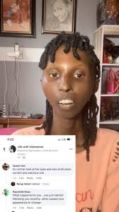 Scleroderma happened 😌, The cause of Scleroderma is unknown , Scleroderma  is an autoimmune disease that causes inflammation and thickening in the  skin and other areas of the body . It also affects the ...