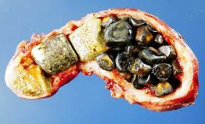 Image result for Gallstone