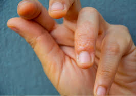 Image result for dyshidrosis