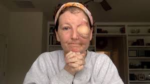 ABC-7 TV in New York City Features VECTRA® WB360 in Melanoma May Segment