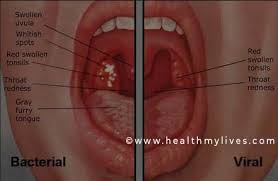 Terdapat pelbagai cara rawat untuk penyakit ini. Pharyngitis Causes Symptoms And Prevention