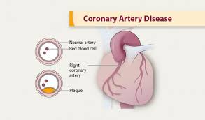 Headaches and dizziness online course: Coronary Artery Disease Cdc Gov