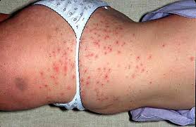 Either could present with what looks like a boil. Straight No Chaser Hot Tub And Barbershop Folliculitis Yep Even More Staph Infections Jeffrey Sterling Md