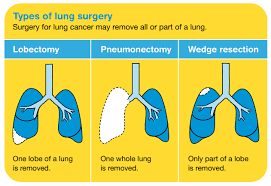 More men than women develop lung cancer. Lung Cancer Treatment Cancer Council Victoria